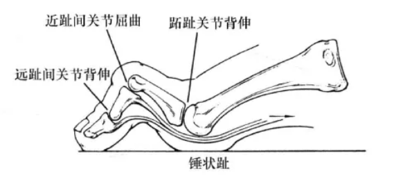 脚趾弯曲像“锤子”？警惕可能是锤状趾