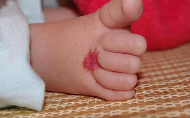 婴儿轻度血管瘤图片图片
