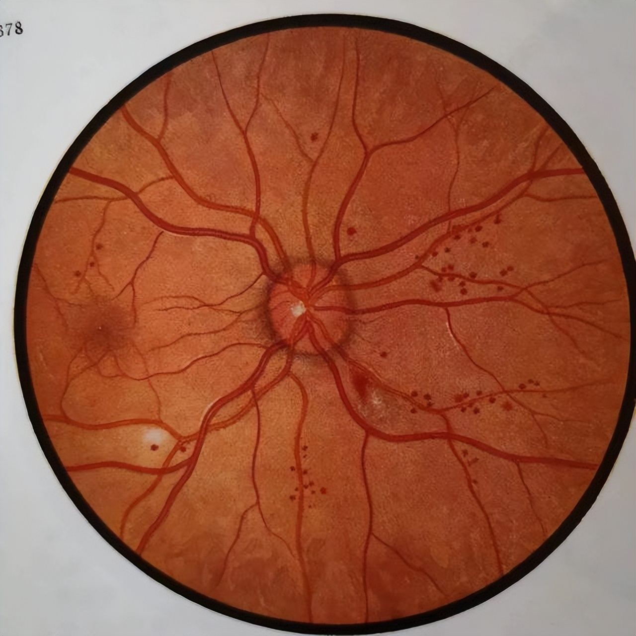 防治糖尿病并发症先"上眼"(二)眼底出血怎么办?