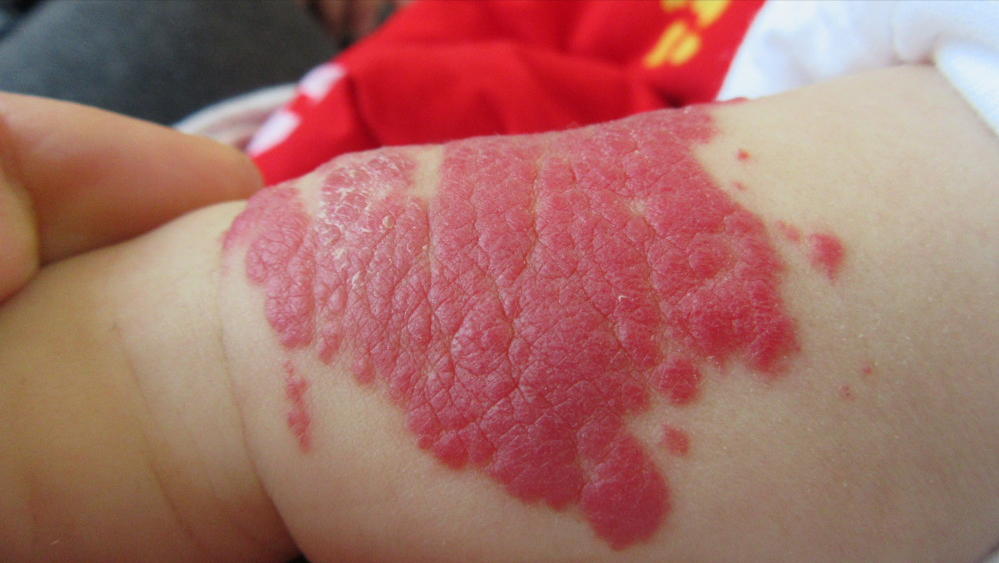 模范!孩子身上的胎记是怎么生成的"恭贺新禧"-第1张图片-寻思网