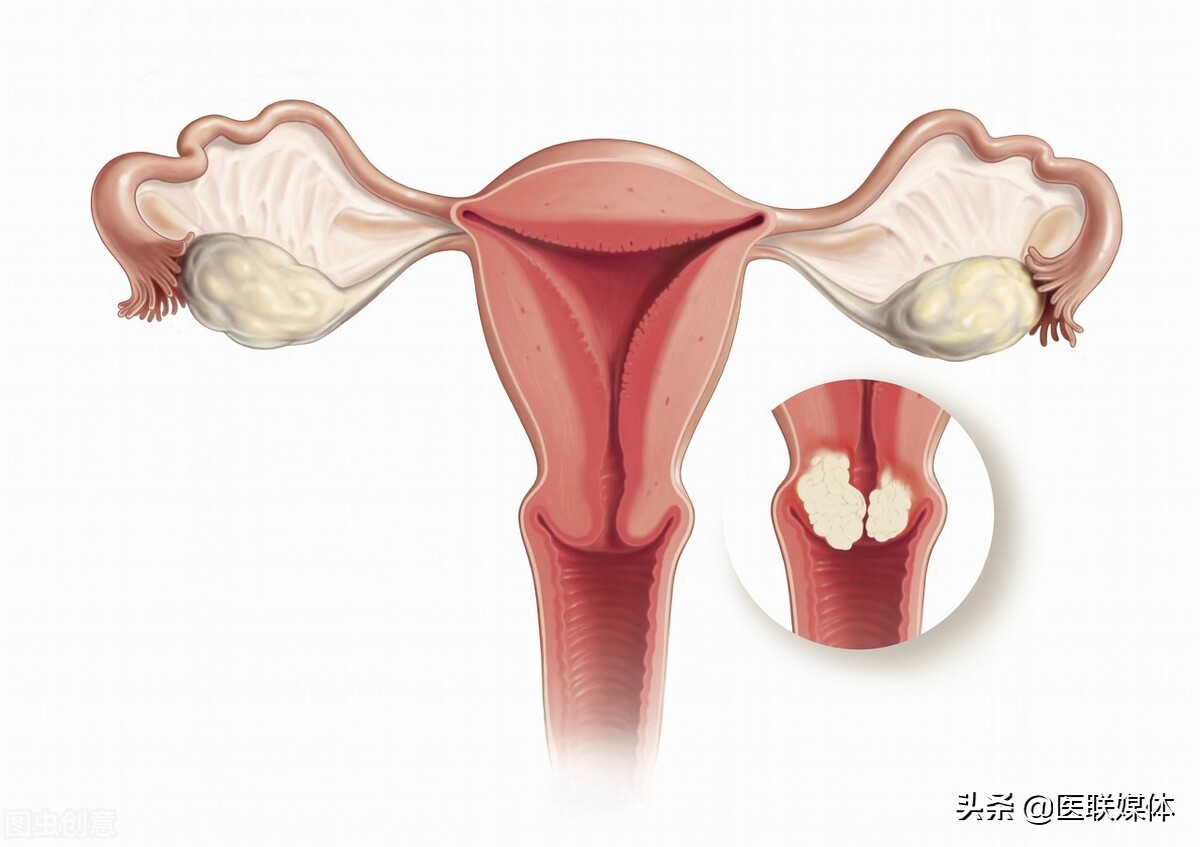 患高血压的女性，更易得子宫内膜癌？这4类人，也要做好预防