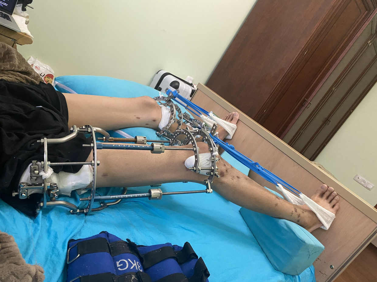 因为有着很大的瘫痪,残疾,截肢风险,断骨增高在不少国家都被禁止用于