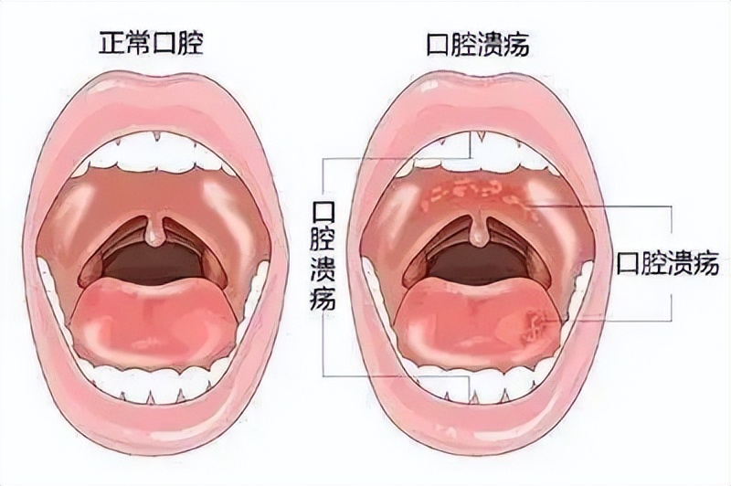 中药诊治不同阶段的口腔溃疡，你属于哪种？