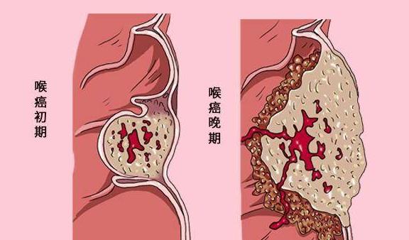 咽炎照片喉癌图片