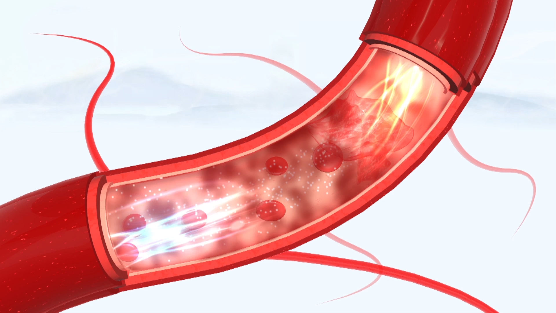血管硬化怎么才能消除和预防(为何血管中脂肪堆积，会导致动脉硬化？斑块可以消除吗，吃什么药)