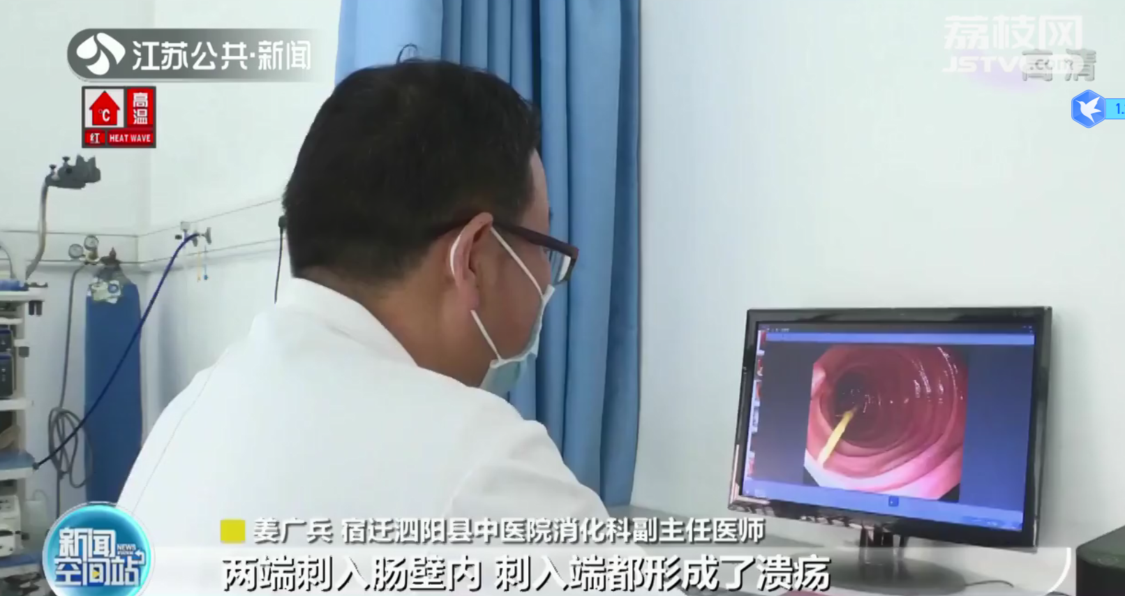 宿迁泗阳：男子喝酒误吞7cm牙签 肚痛3天肠子被刺穿