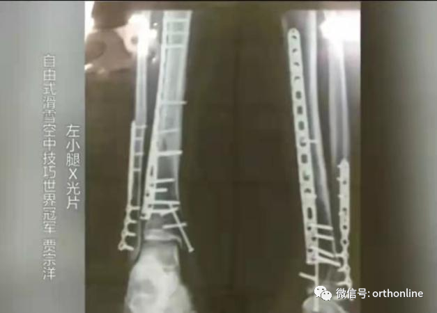 “钢铁侠”贾宗洋无缘奖牌，骨科医生谈22根钢钉背后的心酸