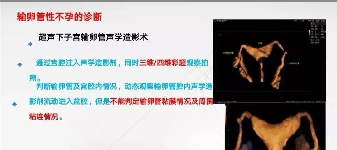 輸卵管造影大概費(fèi)用（輸卵管檢查需要多少錢？輸卵管檢查方法有哪些？）