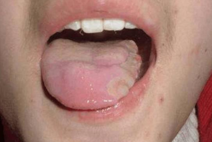 舌癌的原因图片