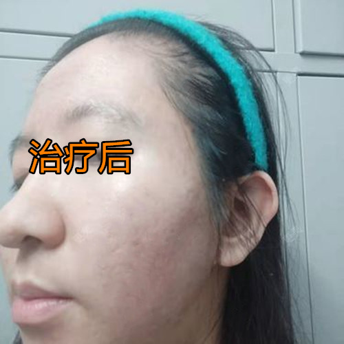 张女士激光治疗后，5年痘坑痘印彻底消失，现在感觉自信了很多