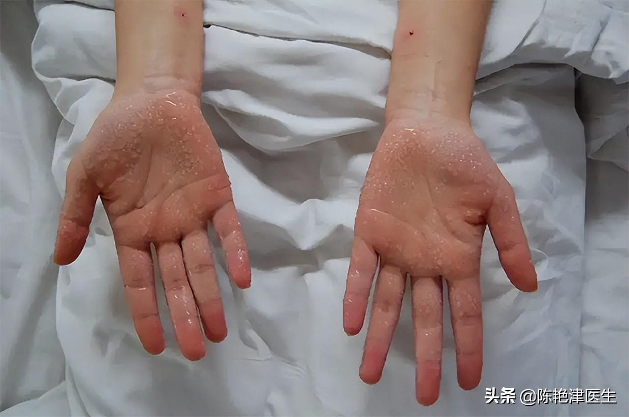 夏天爱出汗,或预示4种疾病!3个部位汗多要注意