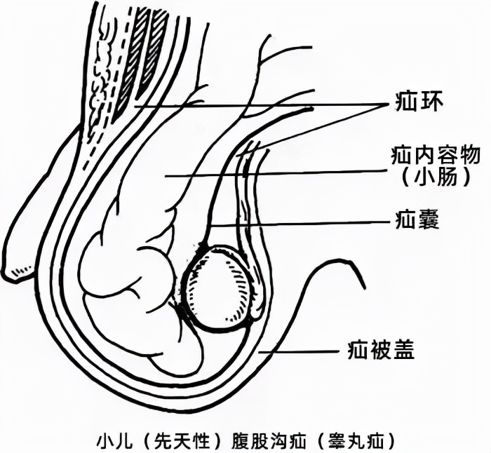 揪心！2个月大早产儿列车上突发疝气，儿童腹股沟疝气该如何预防