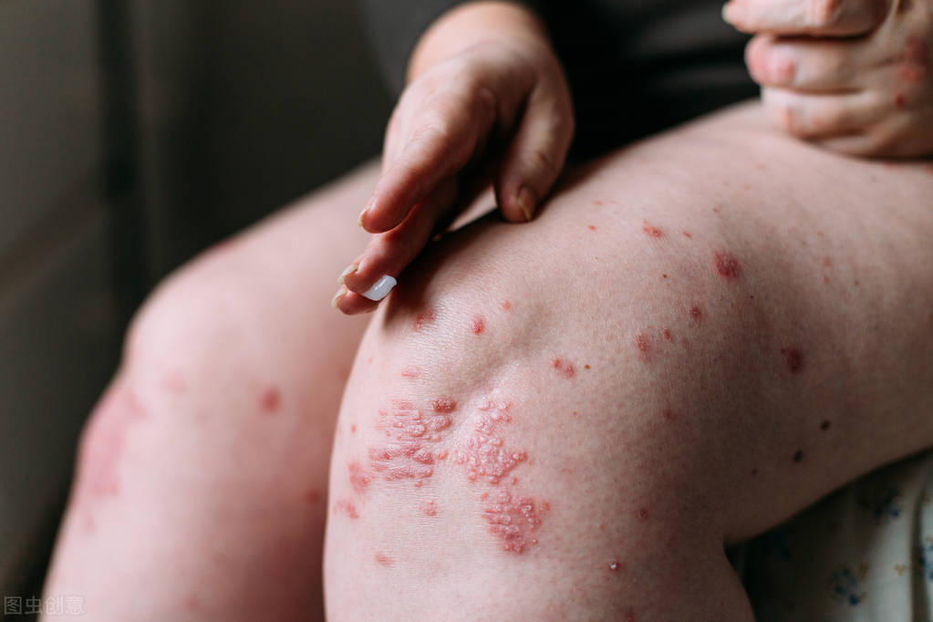 (4)疮疡肿毒,湿疹瘙痒:常配黄芩,黄连,栀子煎服,或配大黄为末,醋调外