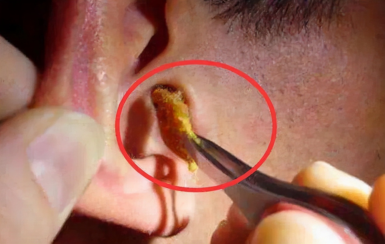 怎么判断耳朵里有耵聍(为什么有的人)