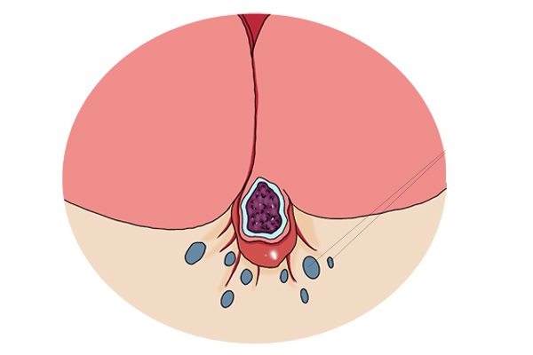 女性外阴瘙痒，与什么有关？尖锐湿疣？湿疹？弄清原因对症治疗