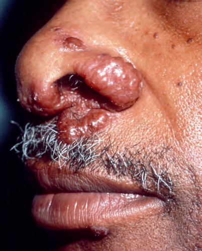 结节病的皮肤改变