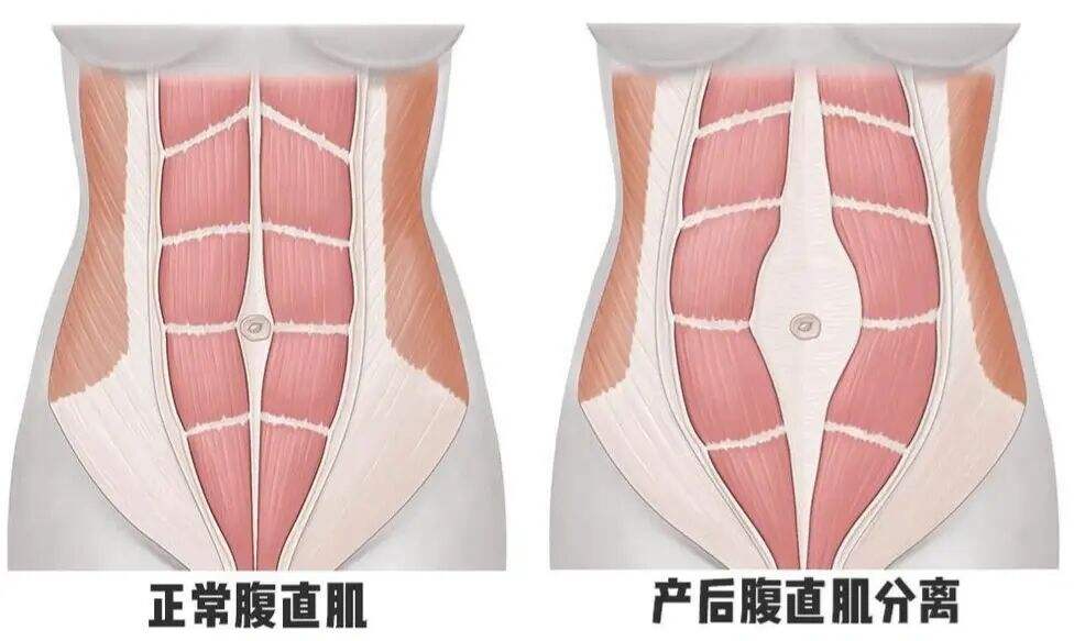 腹部的肌肉,因为怀孕和生产导致分离,腹直肌分离严重的有些是三指甚至