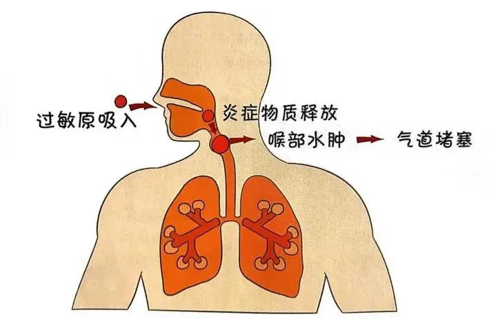 急性喉头水肿导致大三女生不幸病亡，这病对儿童而言更可怕