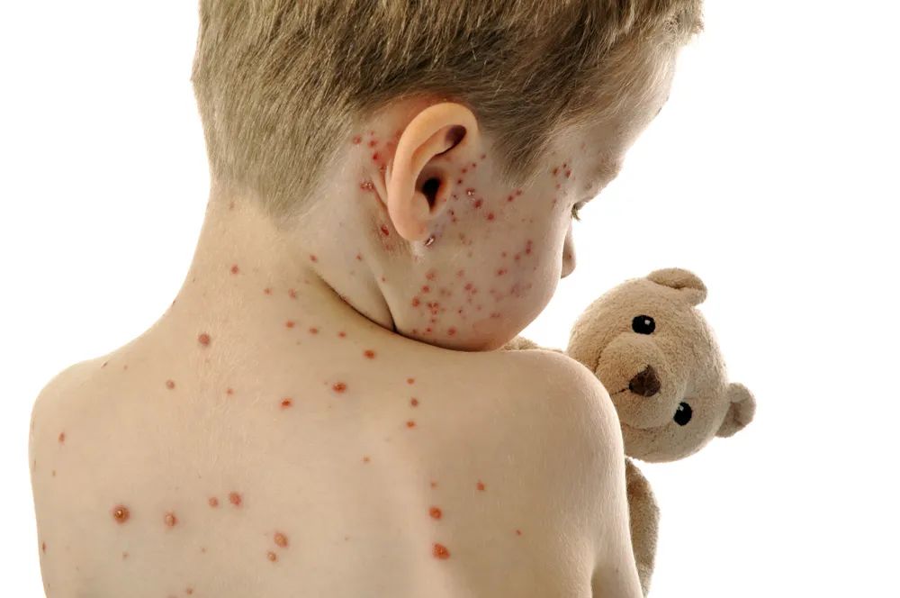 chickenpox)是由水痘