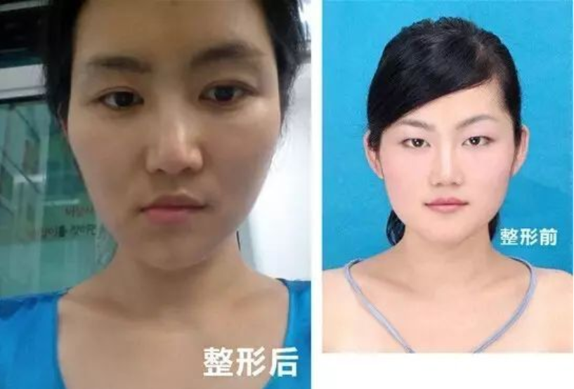 8年前，这个中国姑娘去韩国整容后，她的人生差点被毁掉