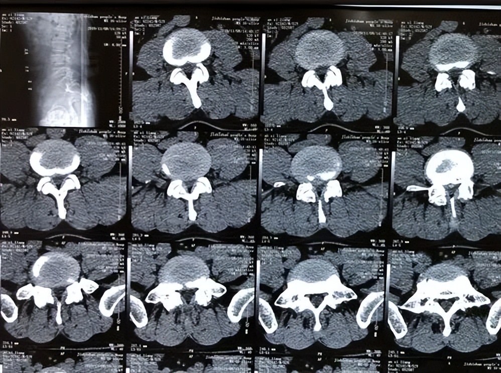 而腰肌劳损在影像学检查中很难