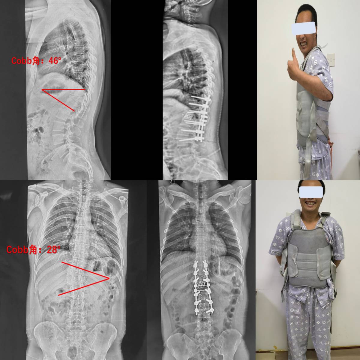 胸椎侧后凸畸形VCR截骨矫形手术帮助35岁小伙挺起脊梁