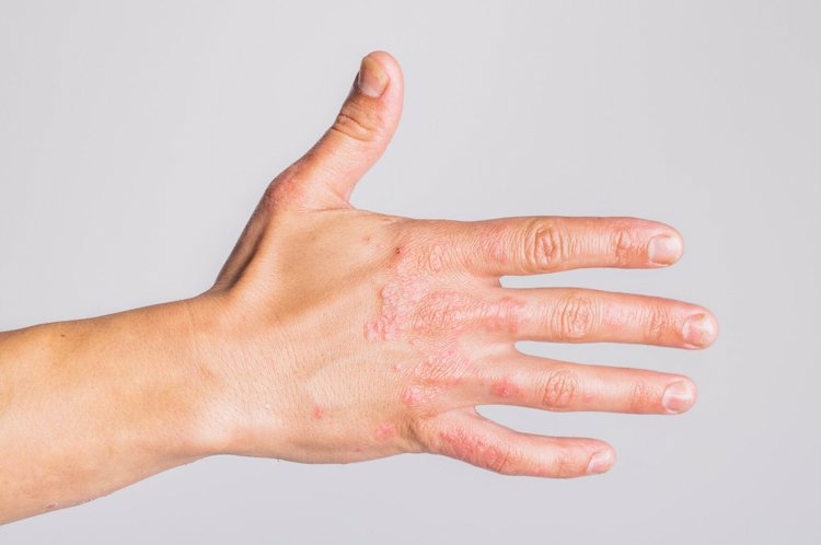 二,3类疾病也可能出现杵状指