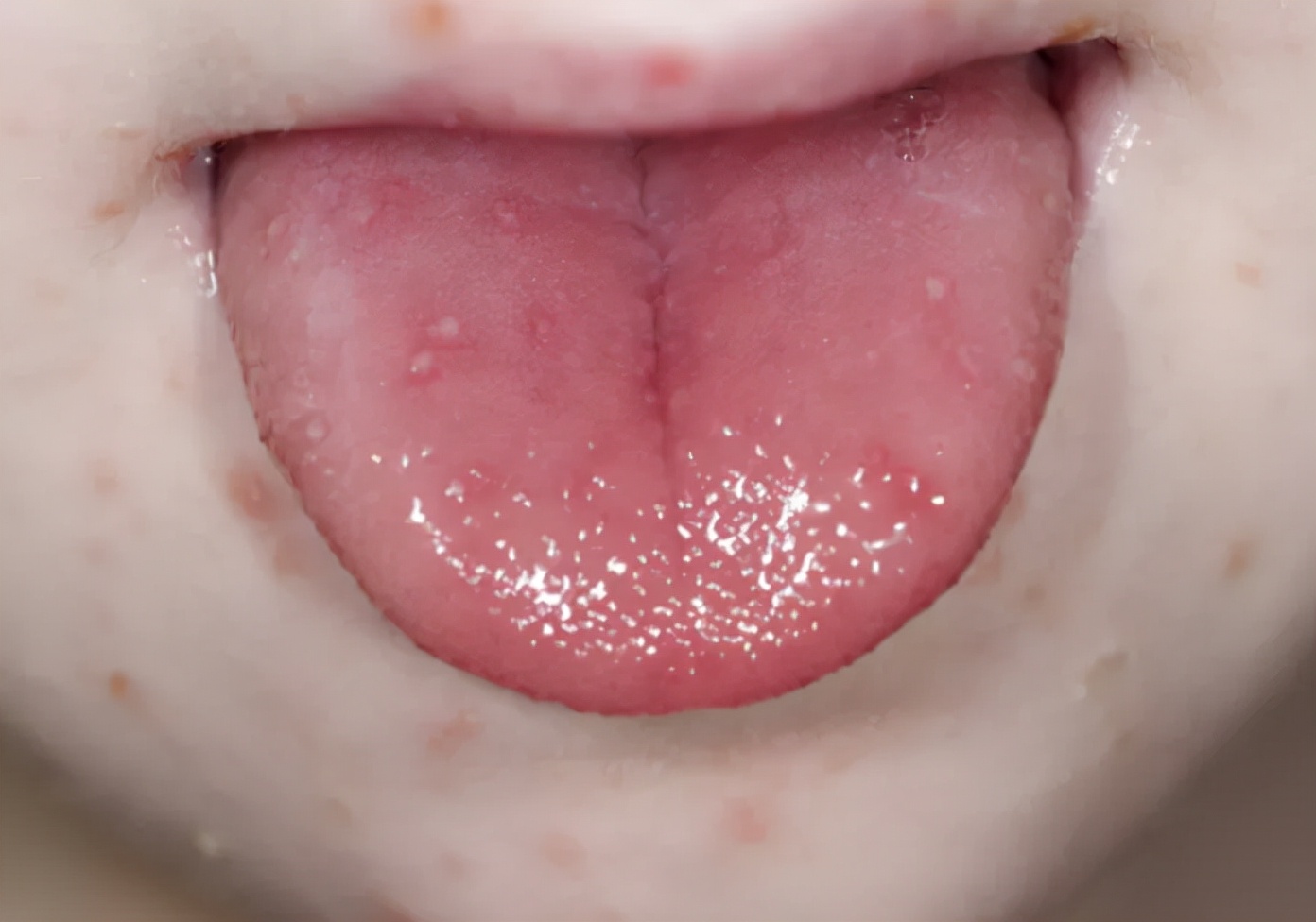 手足口病怎么传染(手足口病) - 摸索网