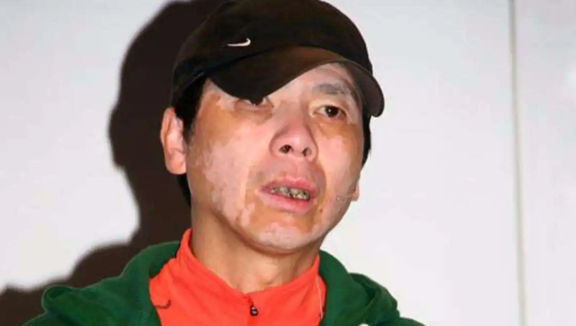 “被顽疾缠身”的7位明星，明明一个比一个有钱，却依旧饱受折磨