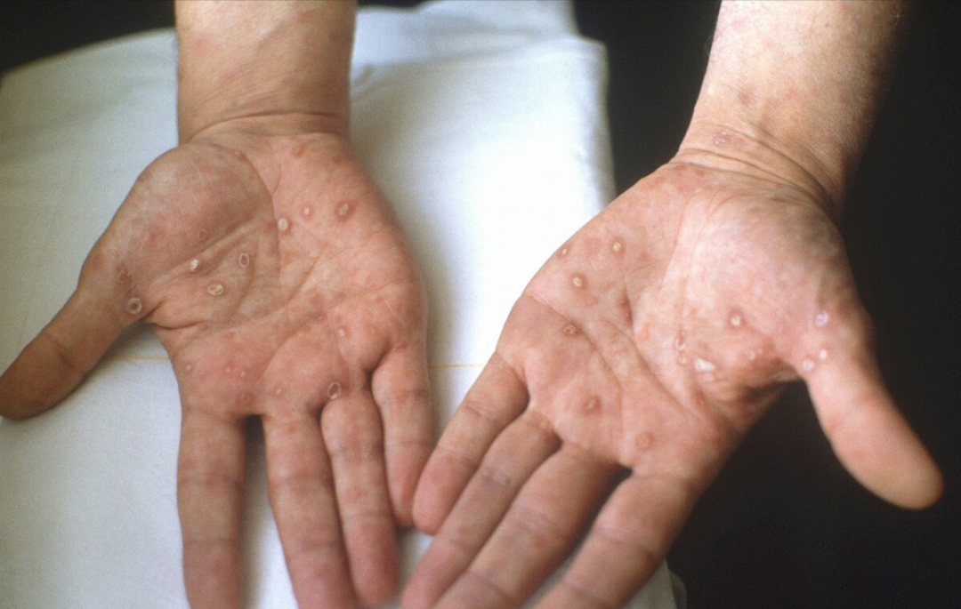 梅毒的症状和图片 女生梅毒的前兆图片-百联百科