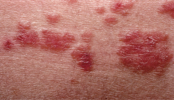 皮损通常无任何不适.1,丘疹型结节病最常发生于面部.