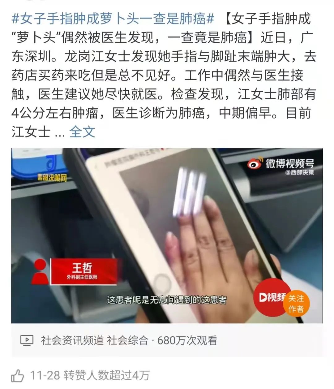 手指杵了(手指肿成“萝卜头”，出现杵状指，一定是肺癌吗？)