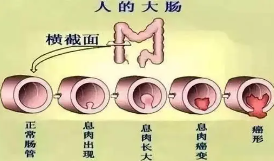 身体5个地方长“黑痣”，或许是肠息肉的“暗示”，要引起警惕