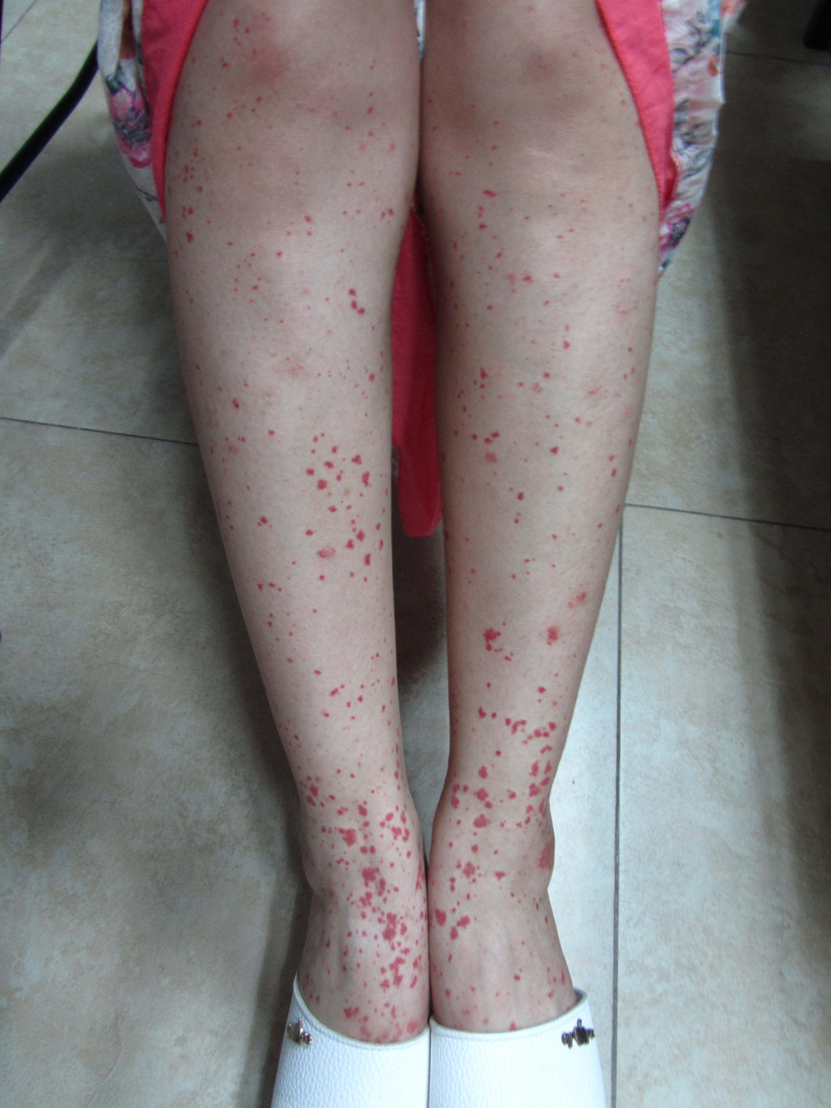 女性腿部过敏性紫癜关于紫癜类的疾病,在中医学中记述的比较分散,因而