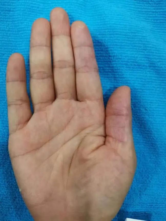 手上濕疹怎么治療（0用藥，只做這件事，就緩解多年頑固手濕疹！）