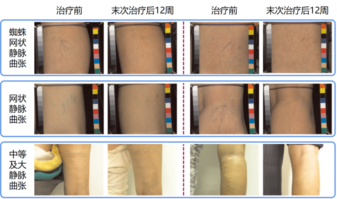 微创、无疤、随治随走-----下肢静脉曲张的硬化剂治疗