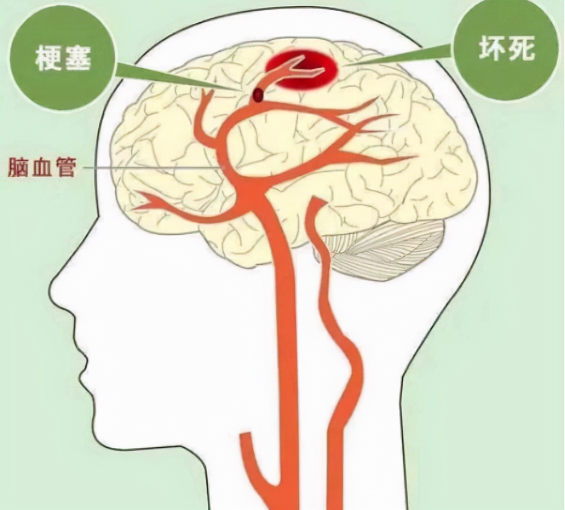 55岁后查脑CT，出现以下4种问题，没必要特殊治疗，别被骗了