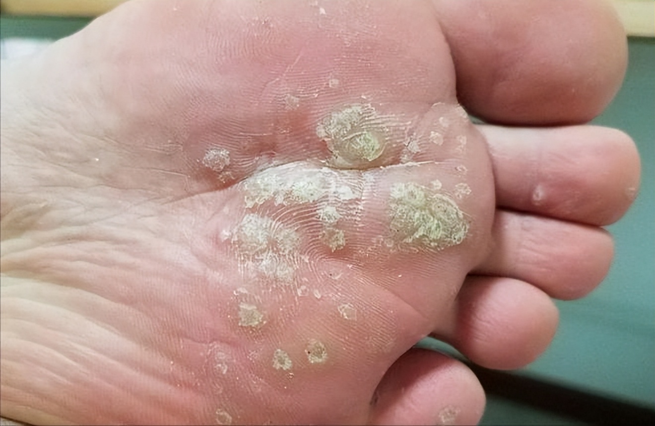 脚上长跖疣怎么办?其实去除并不难,这5种方法收藏好