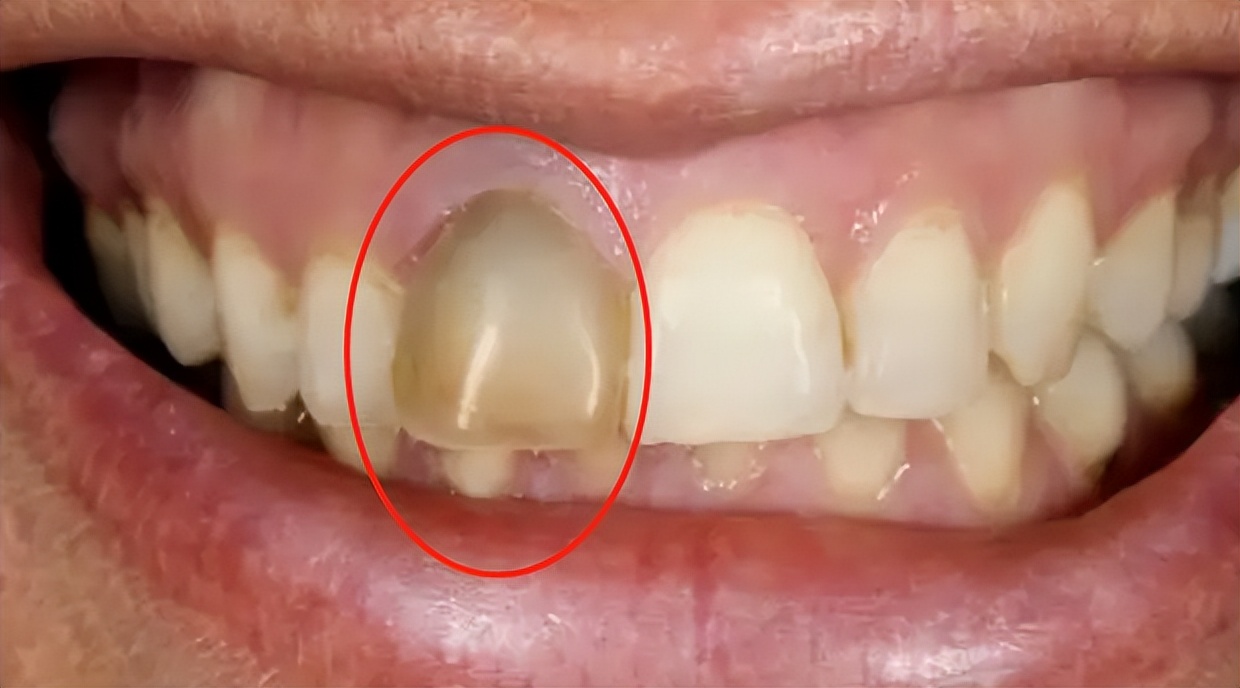 牙齿坏掉图片(3个办法轻松判断牙髓是否坏死) - 赤虎壹号