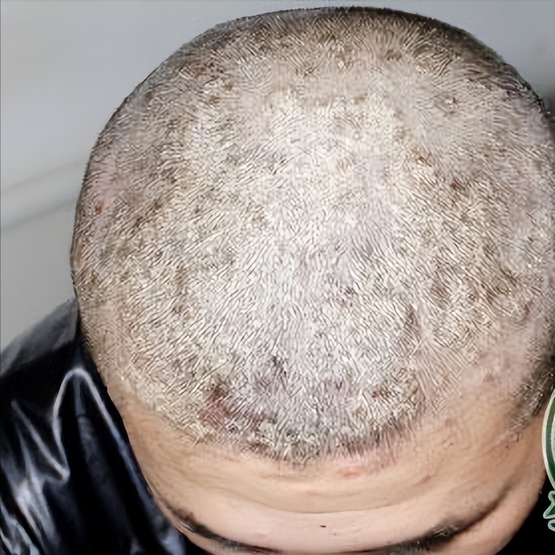 婴儿头上长痘痘图片(头皮上总长疙瘩是怎么回事) - 乐宝宝贝