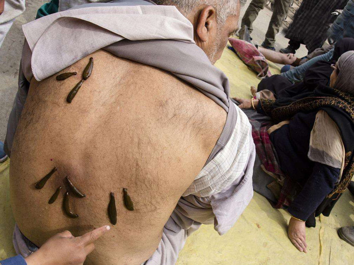 水蛭的价值不止于此