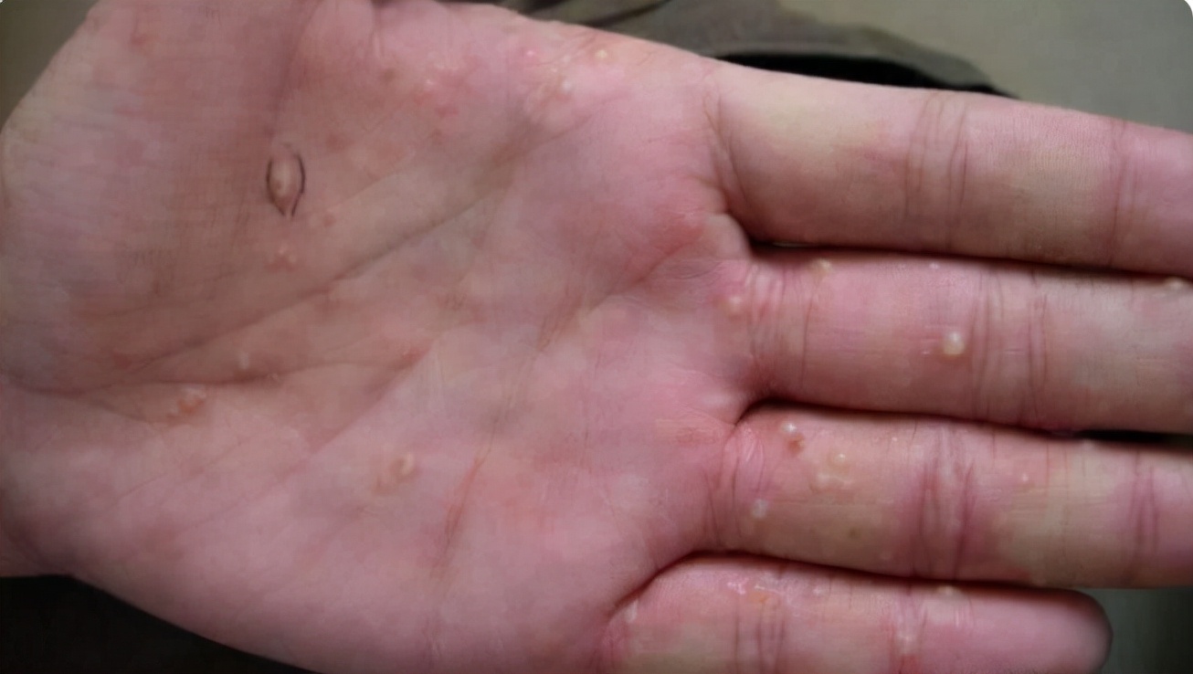 在临床上,汗疱疹又被称为出汗性湿疹,通常出现在春末和初夏,汗水经常