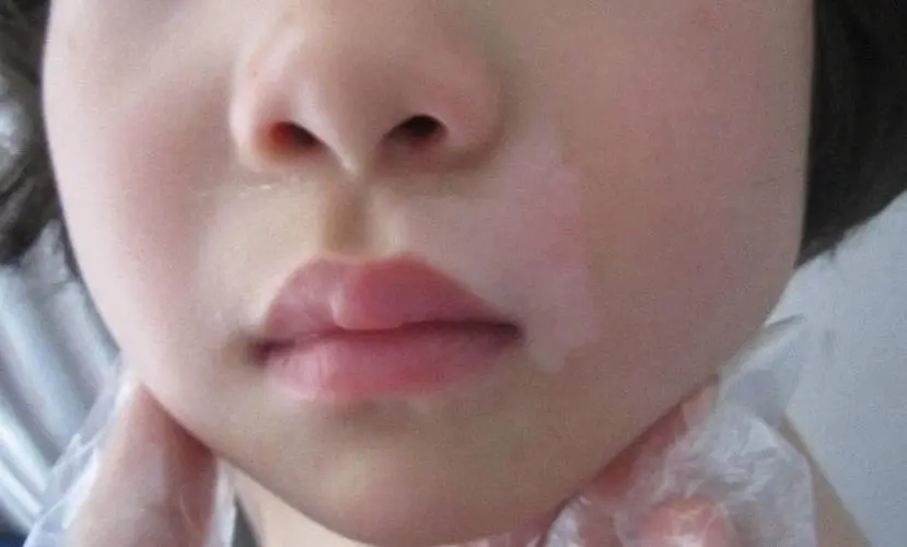 孩子身上出现白斑,怎么判断是不是白癜风?