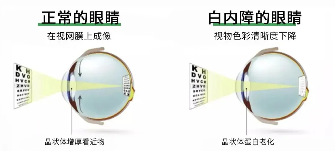 患了白内障怎么办?白内障手术时机怎么选择?2月22日为您答疑