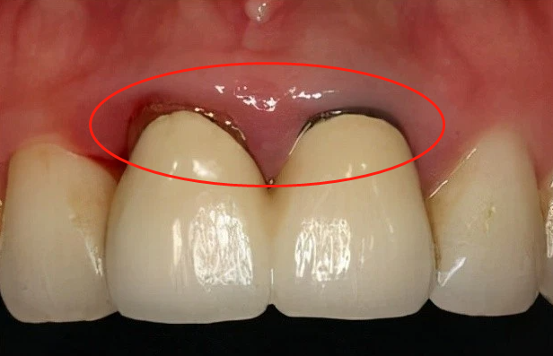 牙龈萎缩怎么治疗 牙龈萎缩怎么补救-蟋蟀号