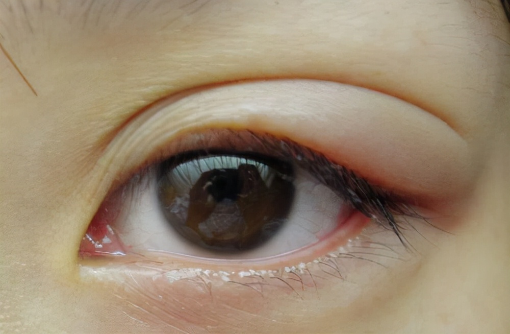 眼睛水肿是肾虚的表现吗?他们有必然的联系吗?