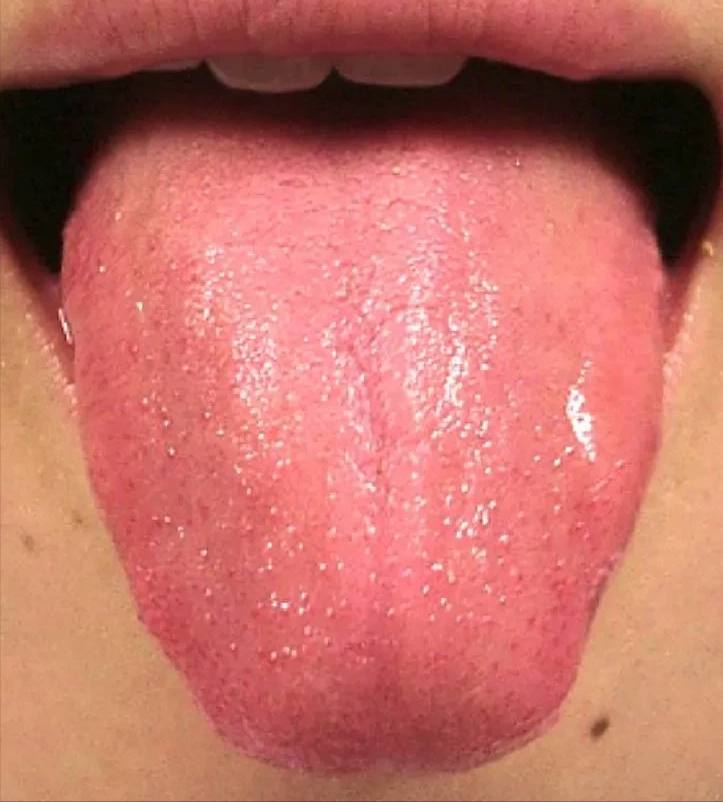 舌苔偏红无苔——阴虚内热