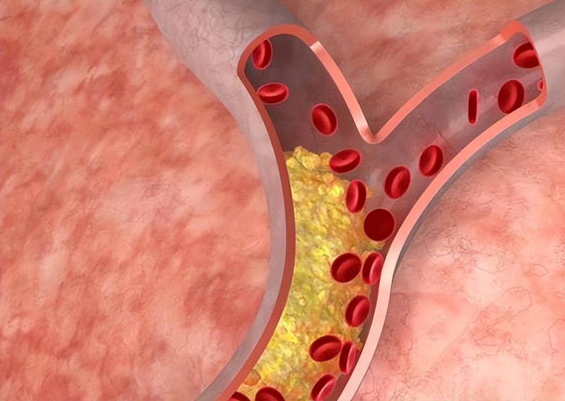 如何"消除"血管斑块?医生:记住这3点,早知早受益