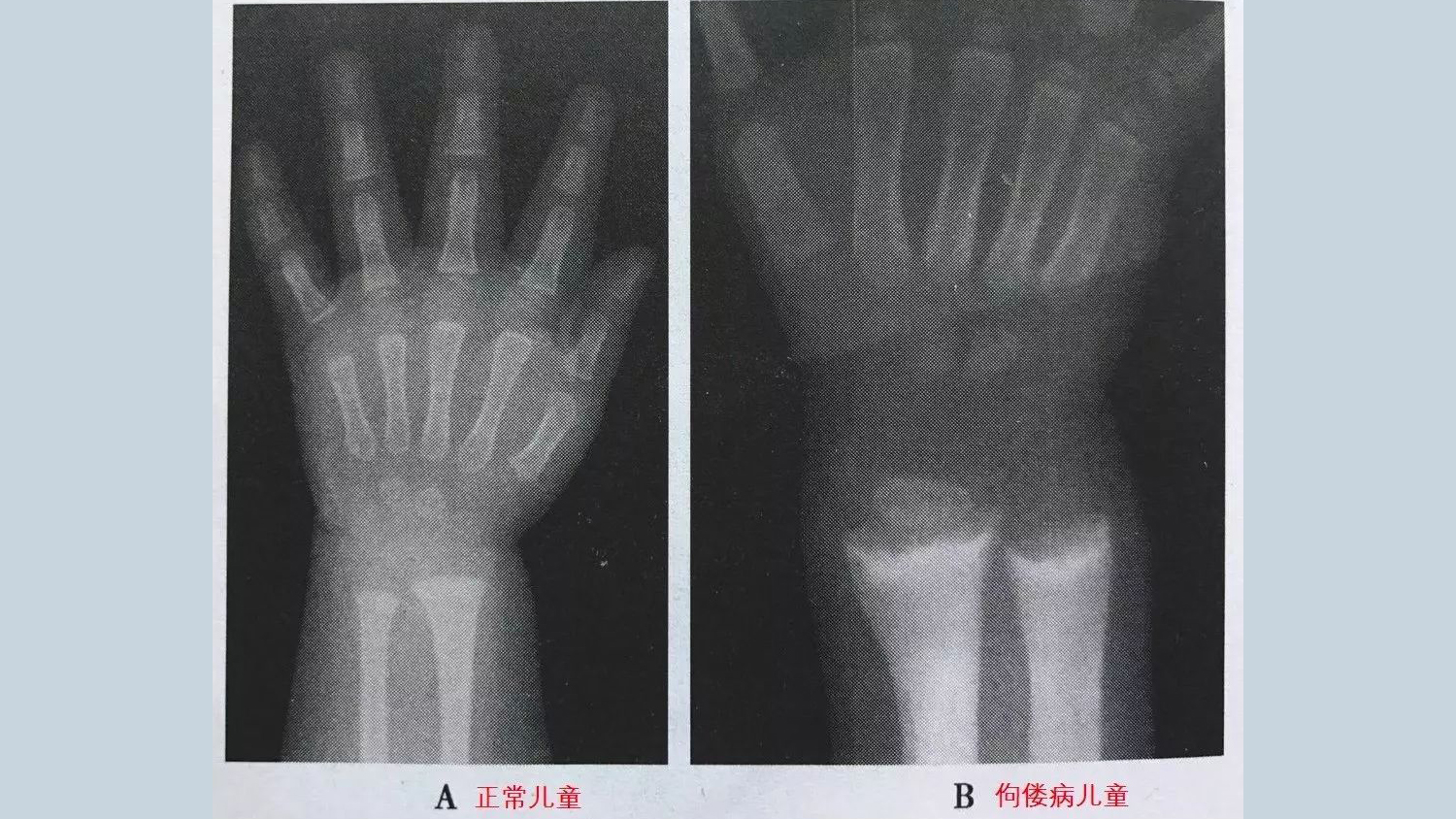 医生提醒:身体出现这些表现,可能是患上佝偻病的征兆!及时检查-蘑菇号