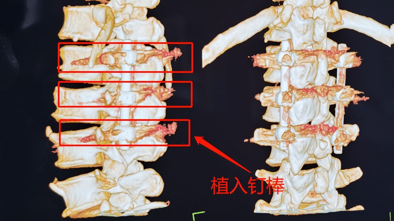 腰椎内固定手术让58岁工人重新挺直腰杆